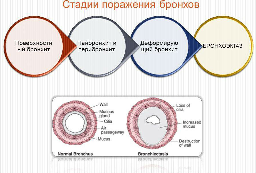 Патогенез острого бронхита презентация