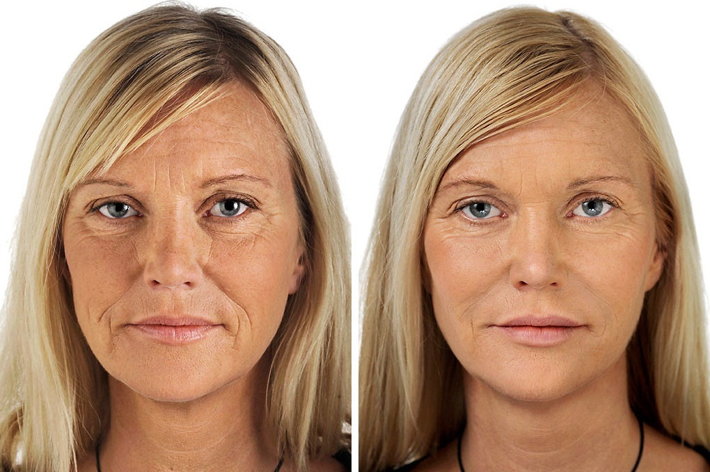 Лице 35. Уколы красоты до и после. Ботокс для лица до и после. Женщина с морщинами. Морщины на лице.