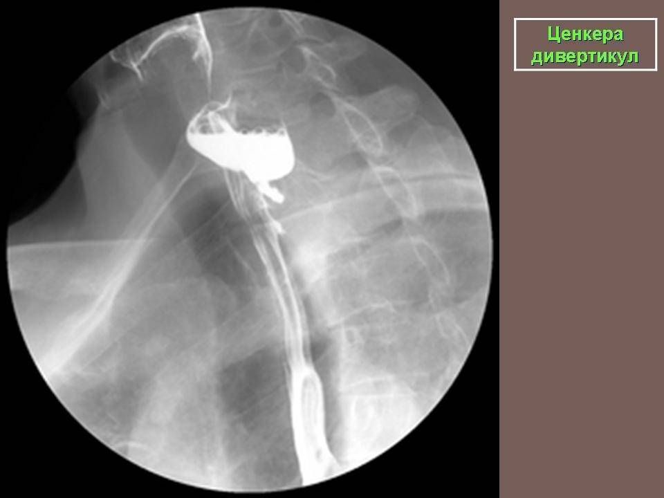 Дивертикул пищевода ценкера